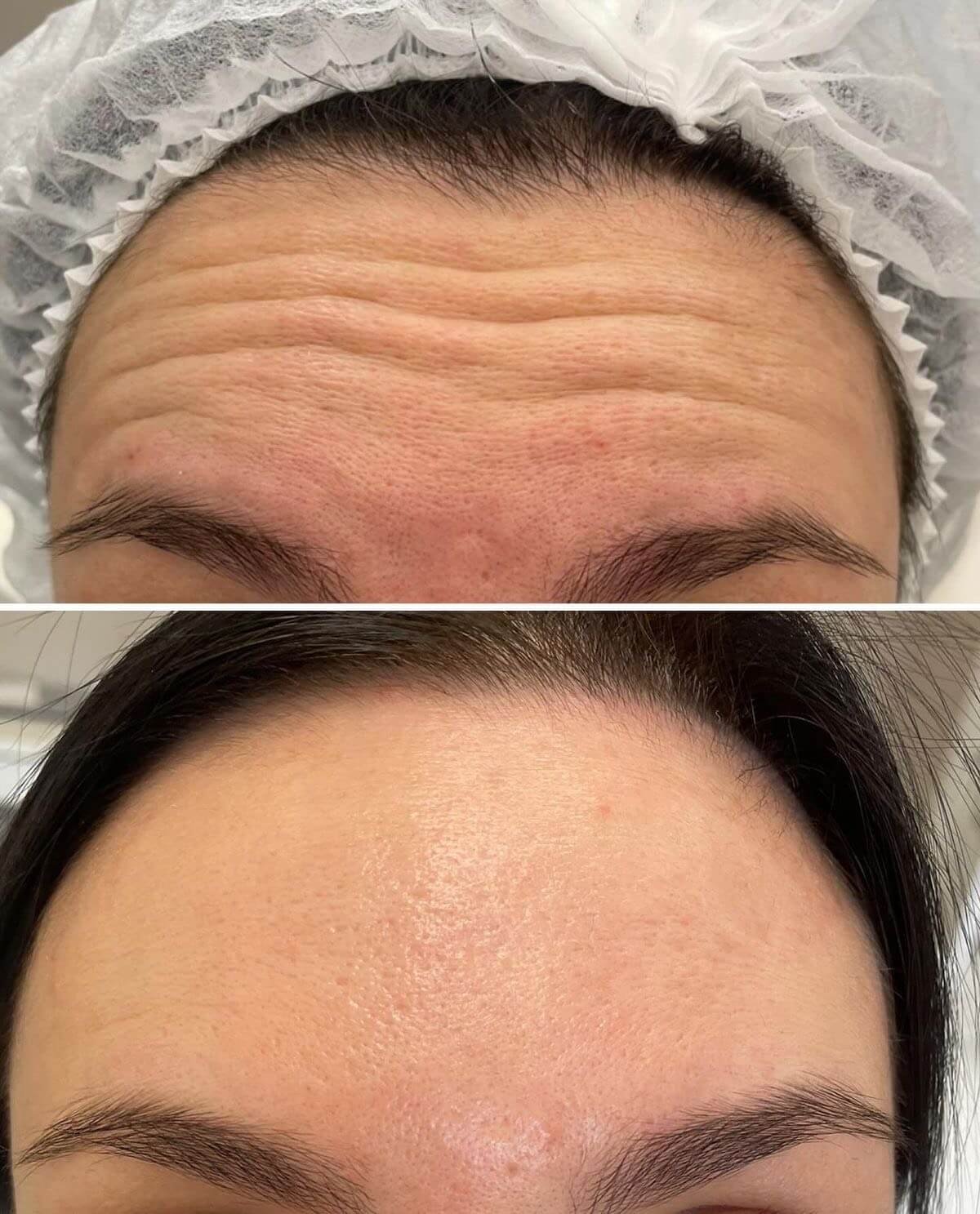 Injectables behandeling Beauty Art Kliniek
