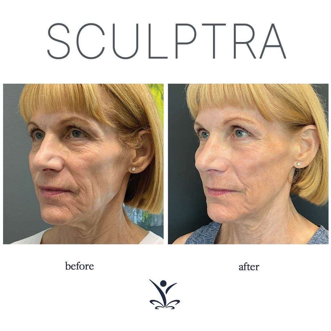 AestheFill of Sculptra vergelijking Beauty Art Kliniek
