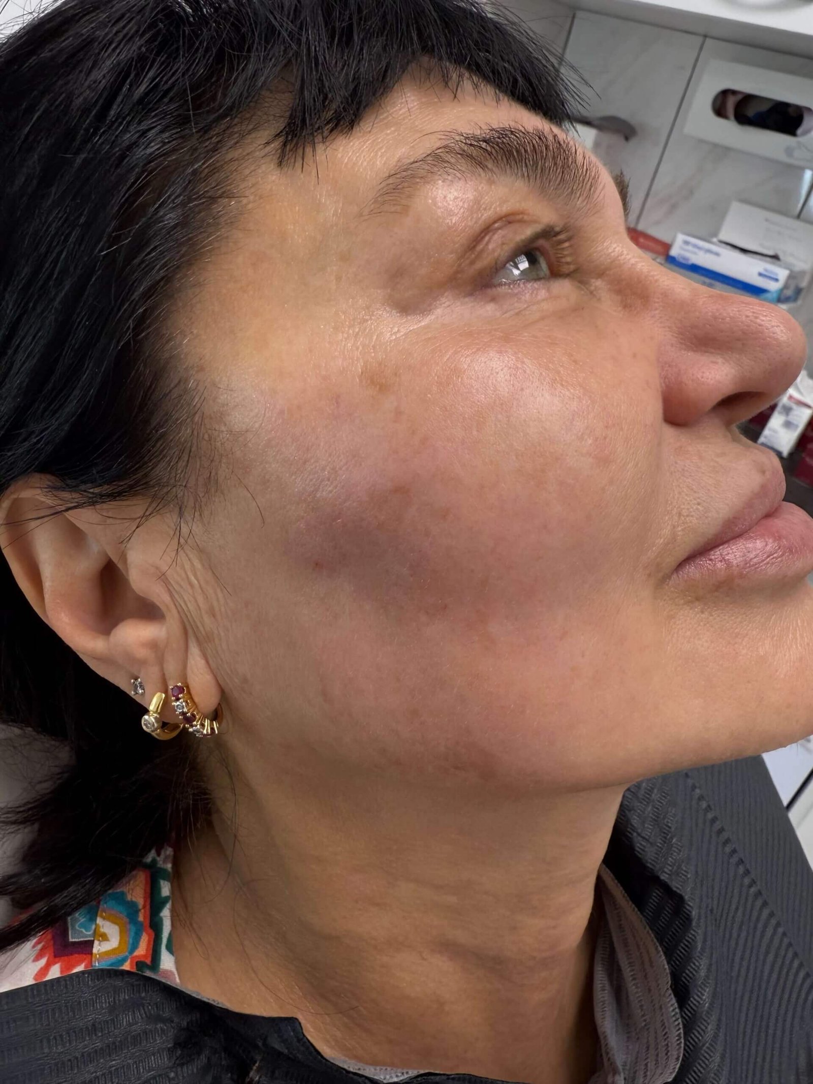 Sculptra – Natuurlijke verjonging met langdurig effect